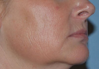 Laser Skin Rejuvenation Before & After Gallery - Patient 184067 - Image 1
