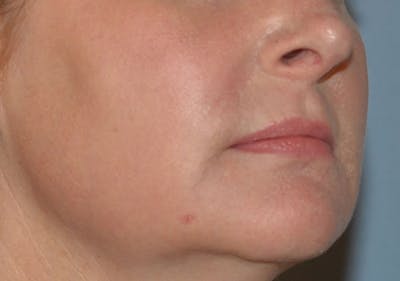 Laser Skin Rejuvenation Before & After Gallery - Patient 184067 - Image 2