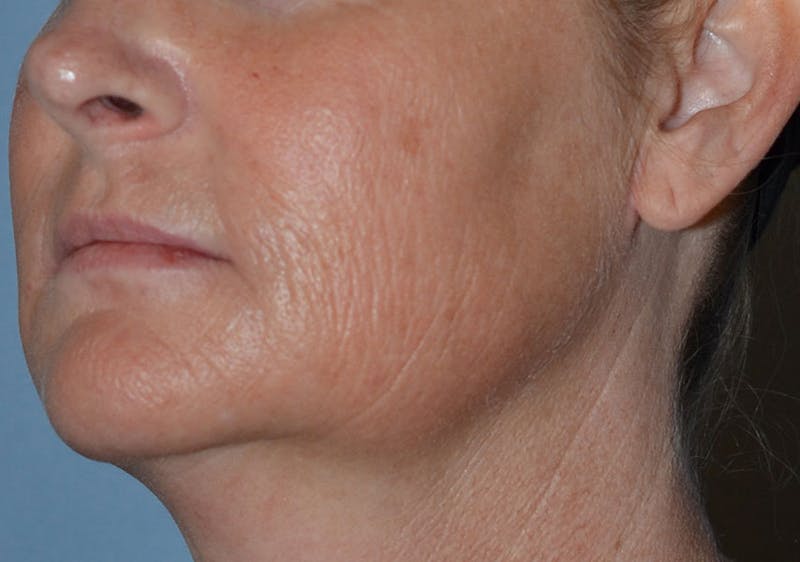 Laser Skin Rejuvenation Before & After Gallery - Patient 184067 - Image 3