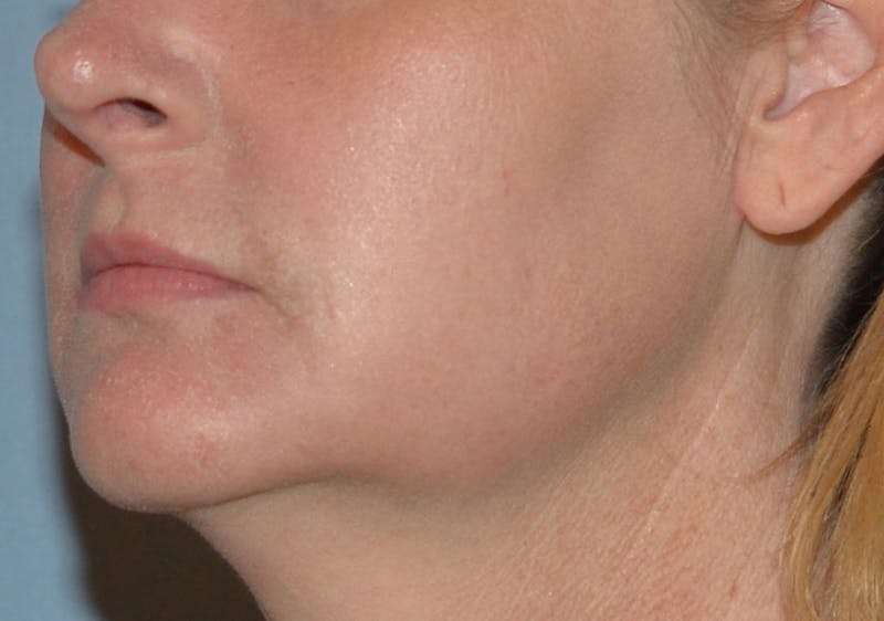 Laser Skin Rejuvenation Before & After Gallery - Patient 184067 - Image 4