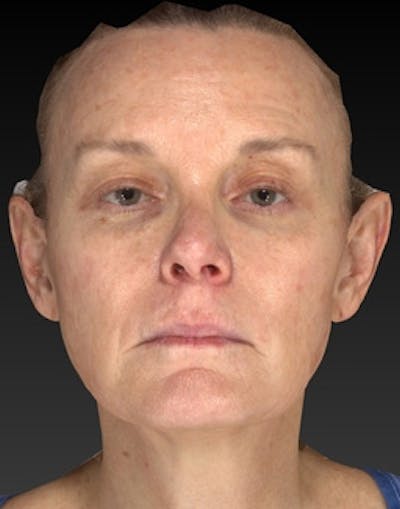 Laser Skin Rejuvenation Before & After Gallery - Patient 125872 - Image 1