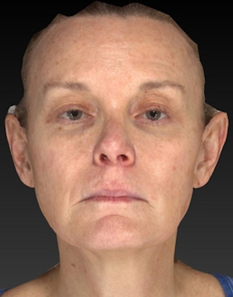 Laser Skin Rejuvenation Before & After Gallery - Patient 125872 - Image 1