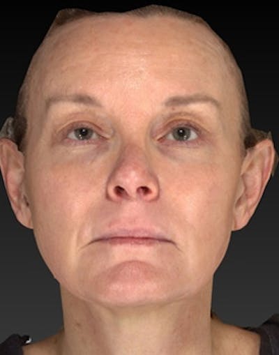 Laser Skin Rejuvenation Before & After Gallery - Patient 125872 - Image 2