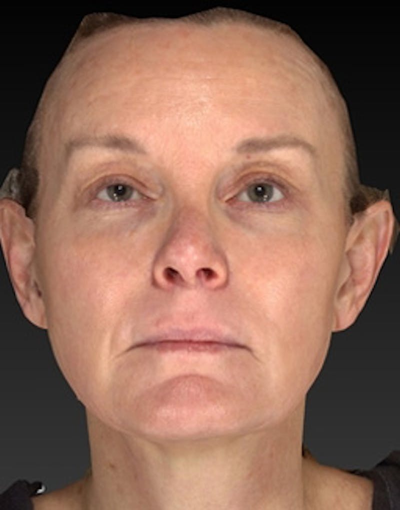 Laser Skin Rejuvenation Before & After Gallery - Patient 125872 - Image 2