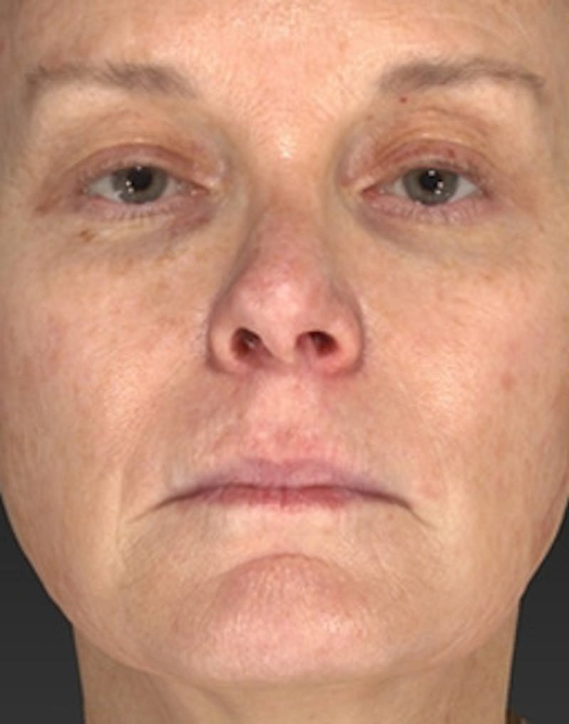Laser Skin Rejuvenation Before & After Gallery - Patient 125872 - Image 3