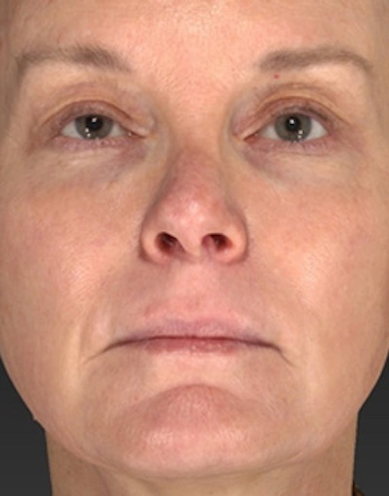 Laser Skin Rejuvenation Before & After Gallery - Patient 125872 - Image 4