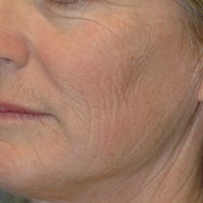 Laser Skin Rejuvenation Before & After Gallery - Patient 316257 - Image 1