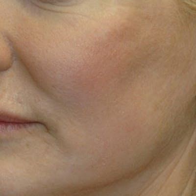 Laser Skin Rejuvenation Before & After Gallery - Patient 316257 - Image 2