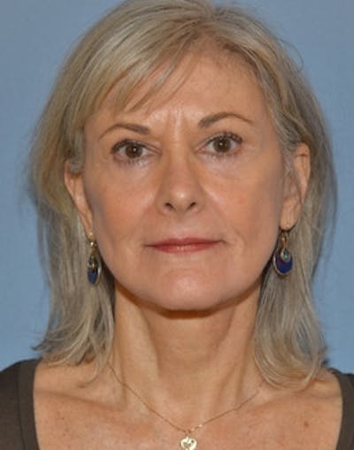 Laser Skin Rejuvenation Before & After Gallery - Patient 119458 - Image 2