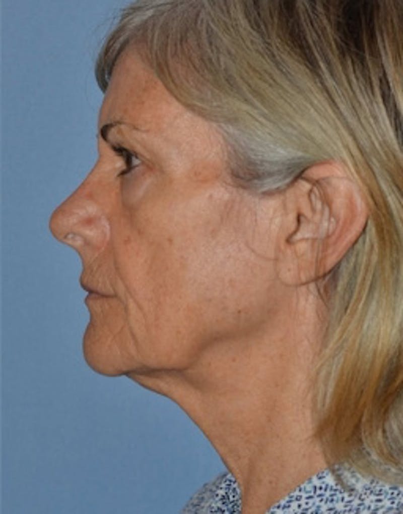 Laser Skin Rejuvenation Before & After Gallery - Patient 119458 - Image 3