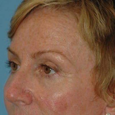 Laser Skin Rejuvenation Before & After Gallery - Patient 415325 - Image 1