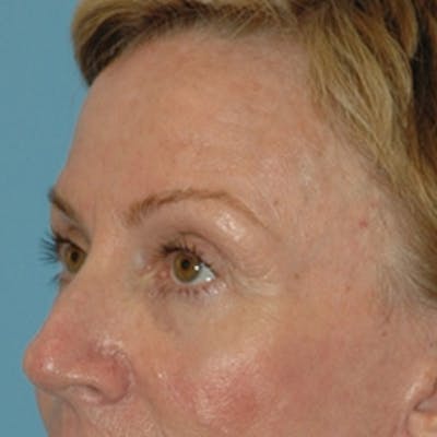 Laser Skin Rejuvenation Before & After Gallery - Patient 415325 - Image 2
