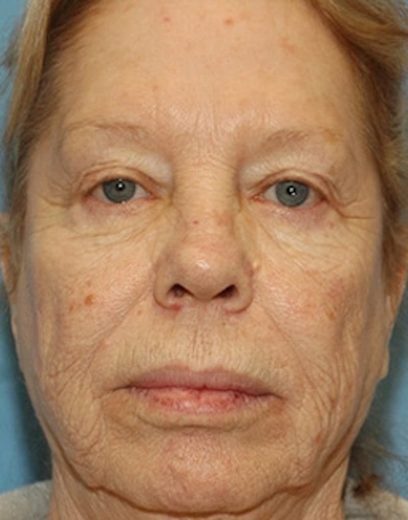 Laser Skin Rejuvenation Before & After Gallery - Patient 333608 - Image 1