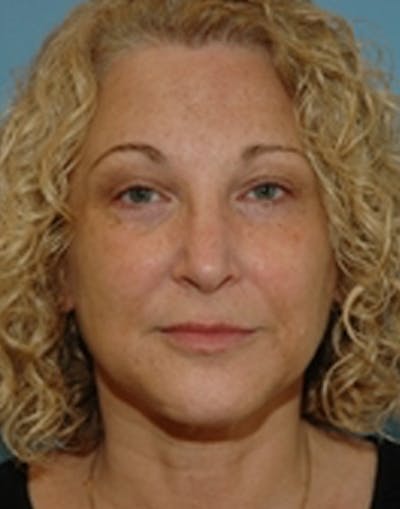 Laser Skin Rejuvenation Before & After Gallery - Patient 952194 - Image 1