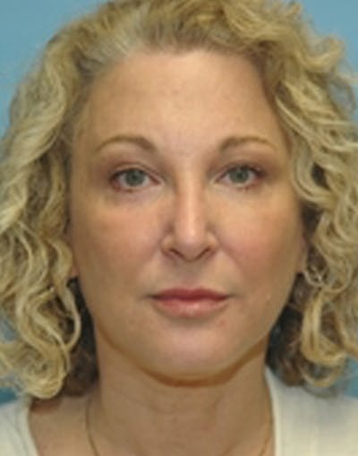Laser Skin Rejuvenation Before & After Gallery - Patient 952194 - Image 2
