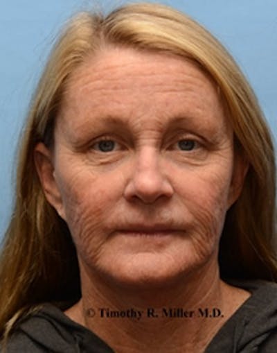 Laser Skin Rejuvenation Before & After Gallery - Patient 943929 - Image 1