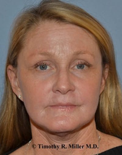 Laser Skin Rejuvenation Before & After Gallery - Patient 943929 - Image 2