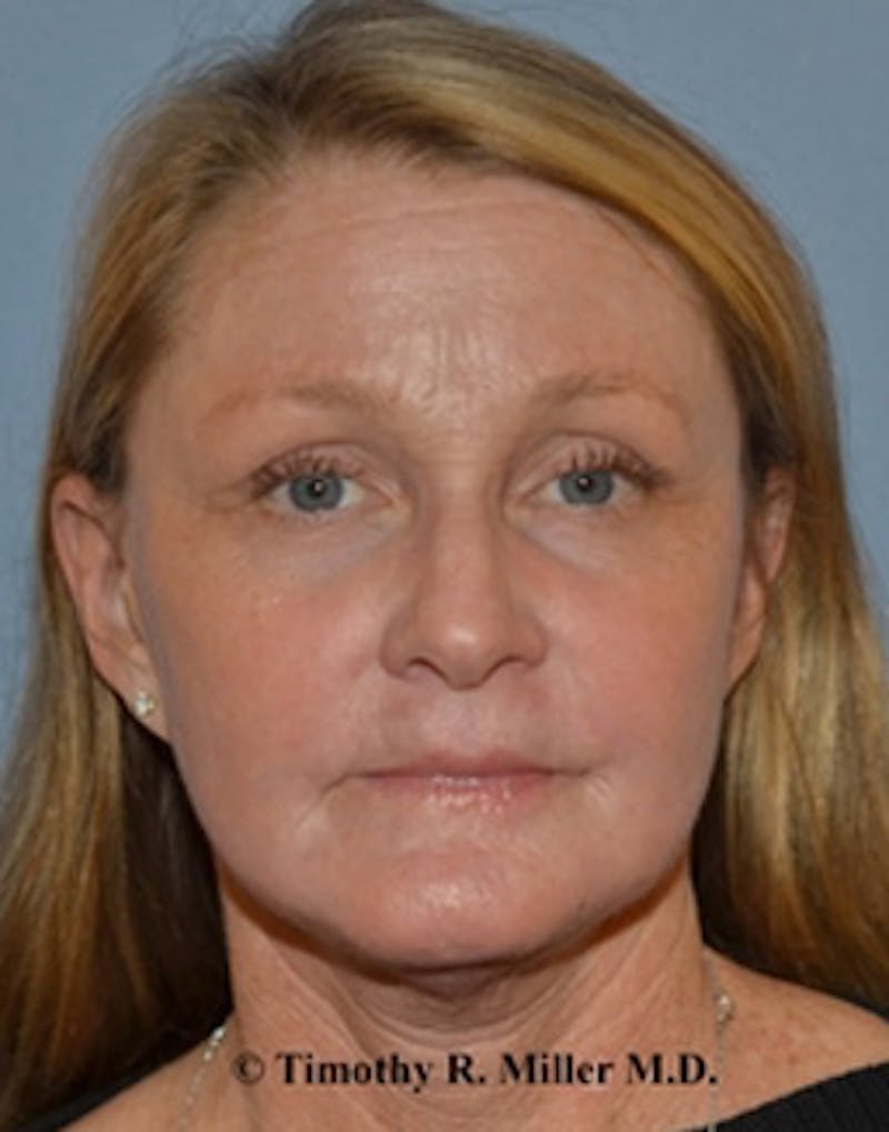 Laser Skin Rejuvenation Before & After Gallery - Patient 943929 - Image 2
