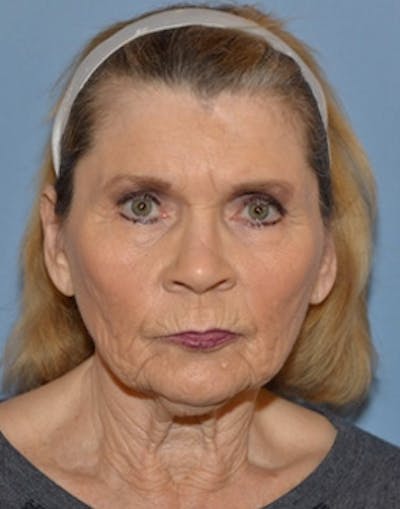Laser Skin Rejuvenation Before & After Gallery - Patient 277735 - Image 1