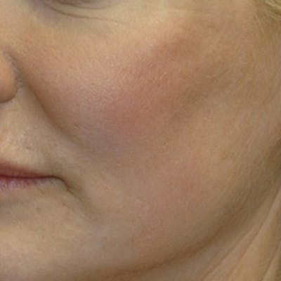 Laser Skin Rejuvenation Before & After Gallery - Patient 285882 - Image 2