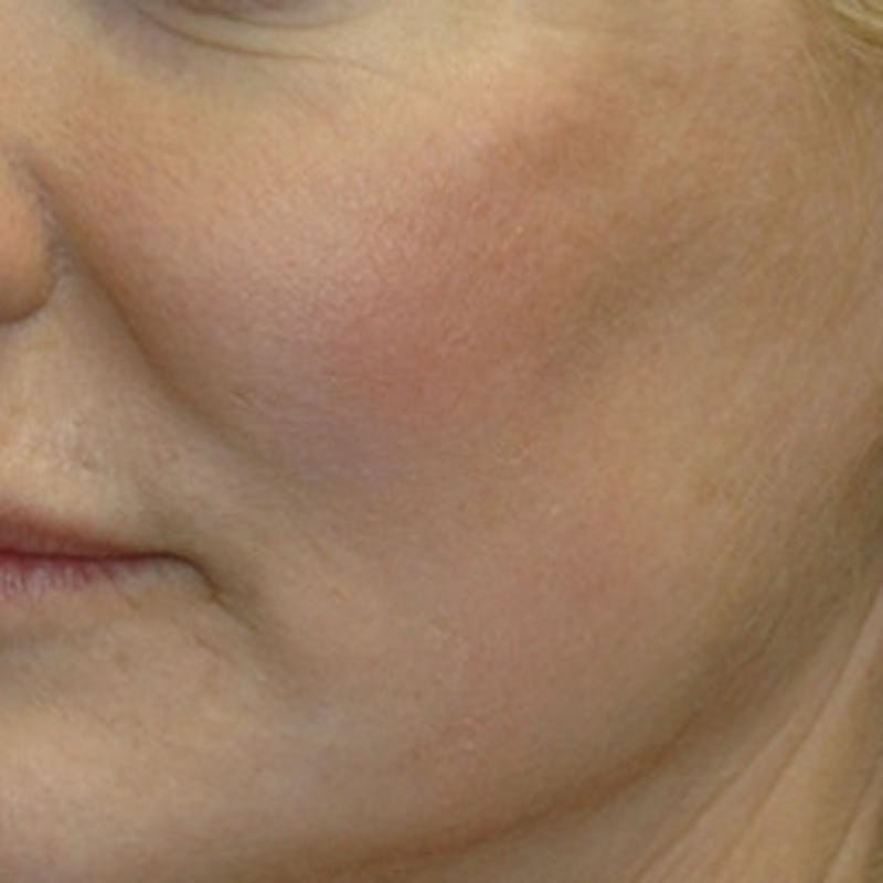 Laser Skin Rejuvenation Before & After Gallery - Patient 285882 - Image 2