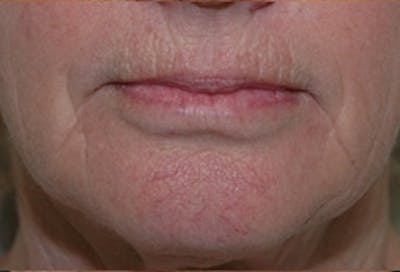 Laser Skin Rejuvenation Before & After Gallery - Patient 322580 - Image 1