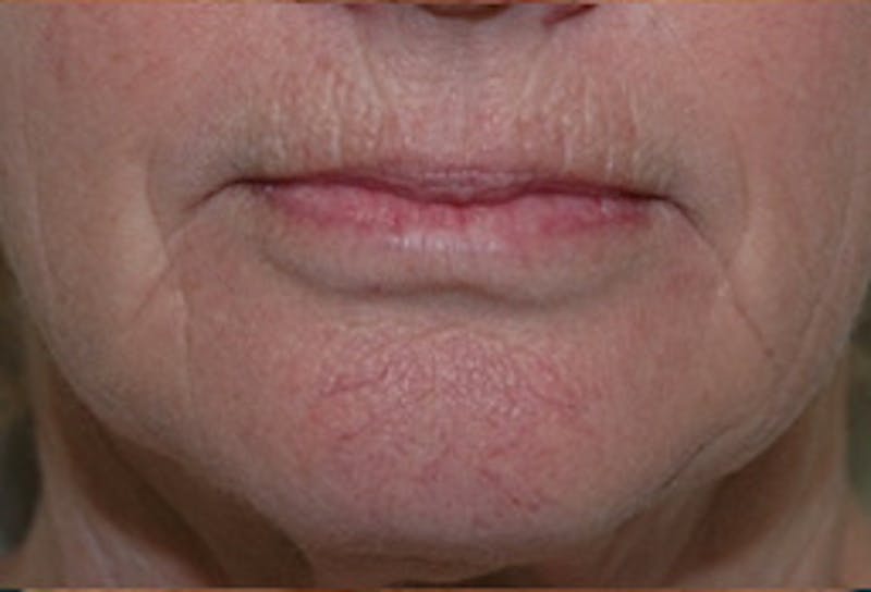 Laser Skin Rejuvenation Before & After Gallery - Patient 322580 - Image 1