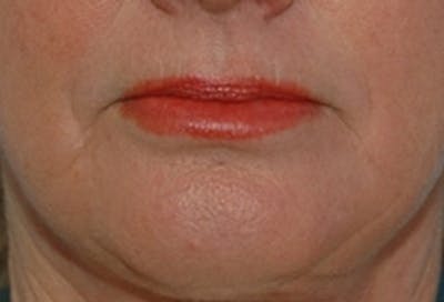 Laser Skin Rejuvenation Before & After Gallery - Patient 322580 - Image 2