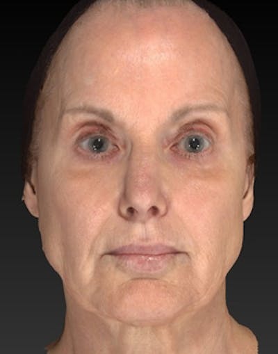 Laser Skin Rejuvenation Before & After Gallery - Patient 275164 - Image 1