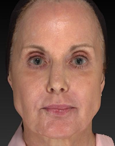 Laser Skin Rejuvenation Before & After Gallery - Patient 275164 - Image 2