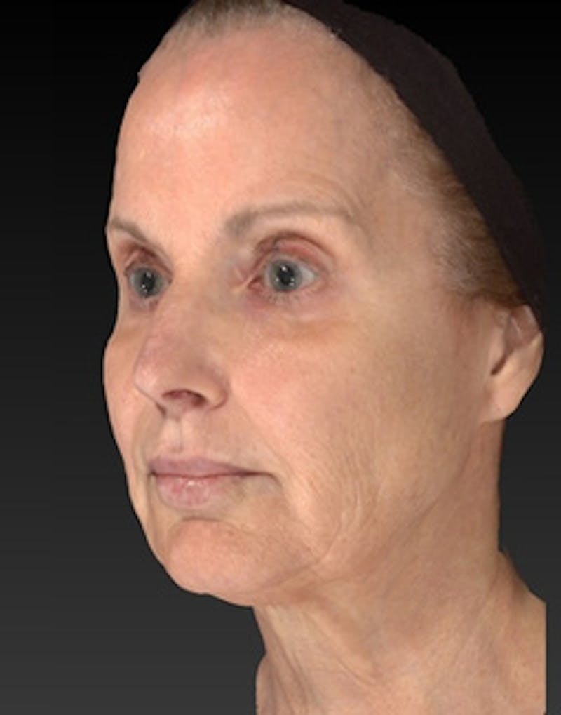 Laser Skin Rejuvenation Before & After Gallery - Patient 275164 - Image 3