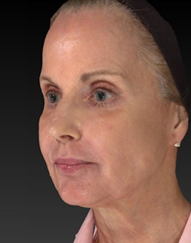 Laser Skin Rejuvenation Before & After Gallery - Patient 275164 - Image 4