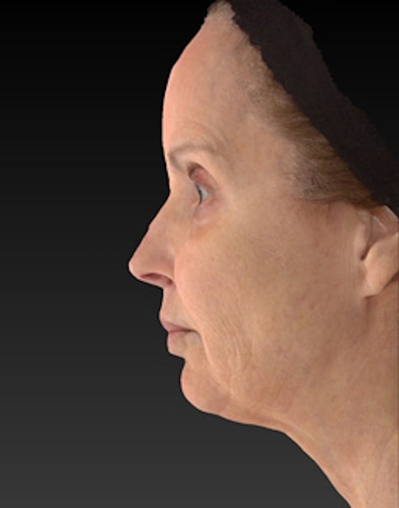 Laser Skin Rejuvenation Before & After Gallery - Patient 275164 - Image 5