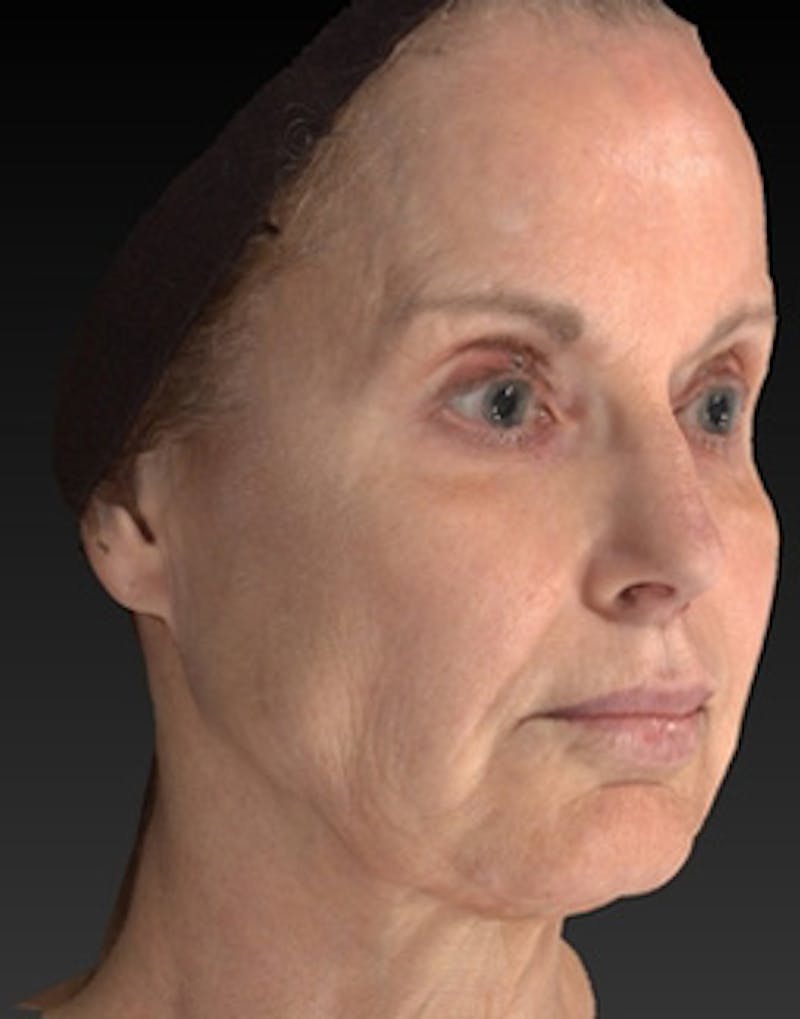 Laser Skin Rejuvenation Before & After Gallery - Patient 275164 - Image 7