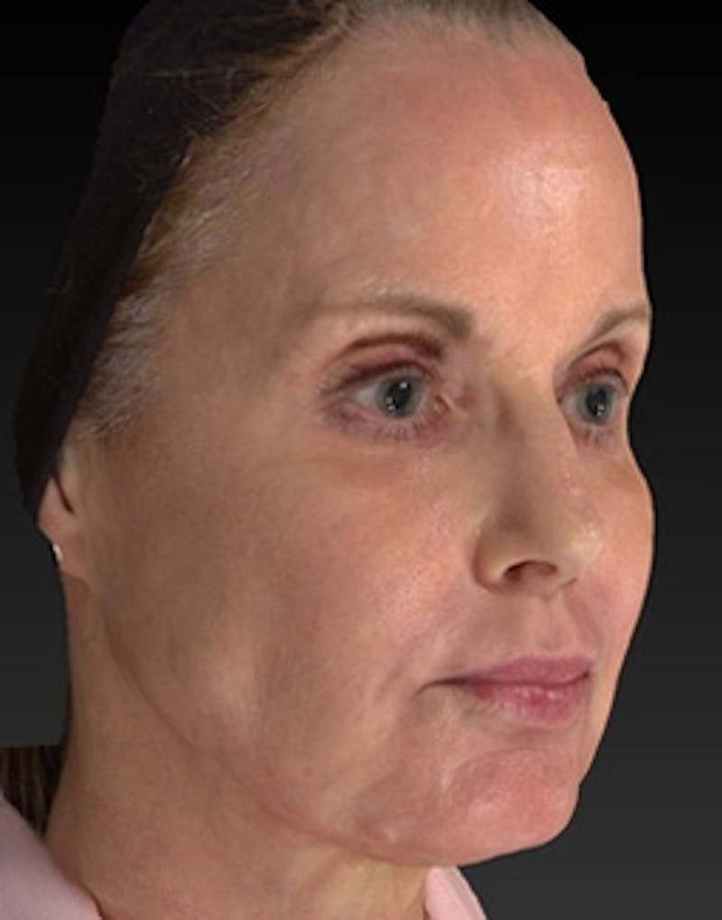 Laser Skin Rejuvenation Before & After Gallery - Patient 275164 - Image 8