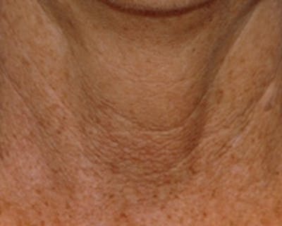 Laser Skin Rejuvenation Before & After Gallery - Patient 298059 - Image 1