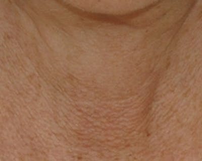Laser Skin Rejuvenation Before & After Gallery - Patient 298059 - Image 2