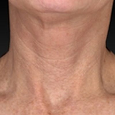 Laser Skin Rejuvenation Before & After Gallery - Patient 265117 - Image 1
