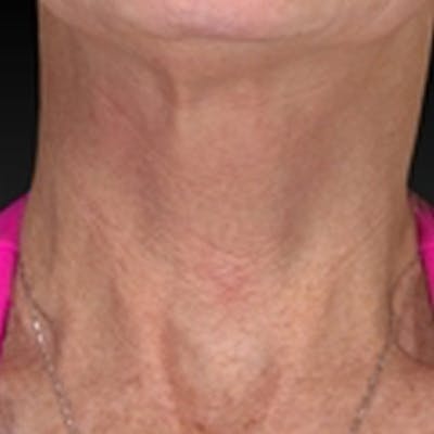 Laser Skin Rejuvenation Before & After Gallery - Patient 265117 - Image 2