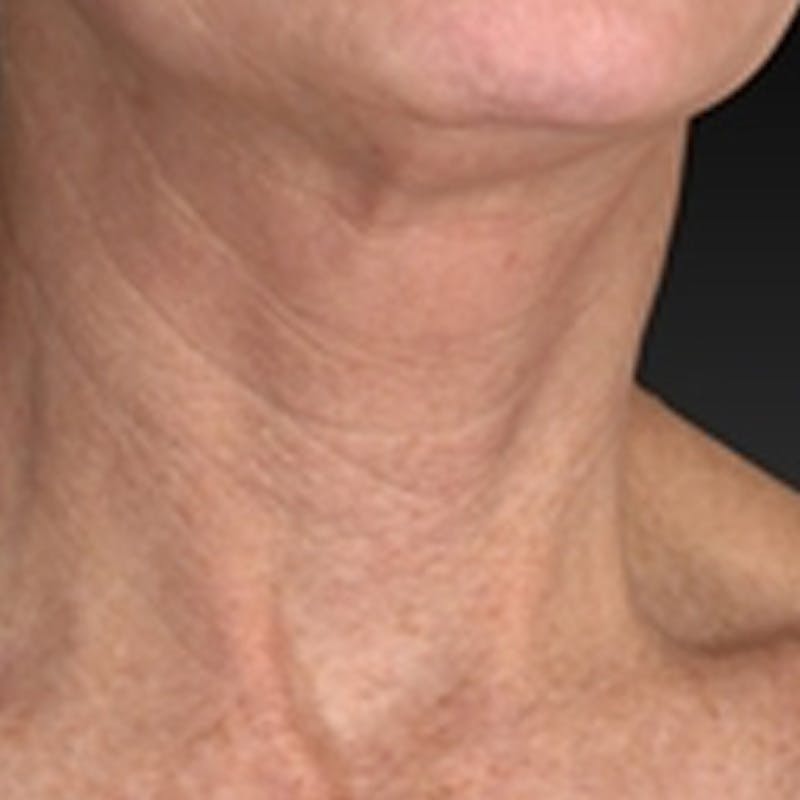 Laser Skin Rejuvenation Before & After Gallery - Patient 265117 - Image 3