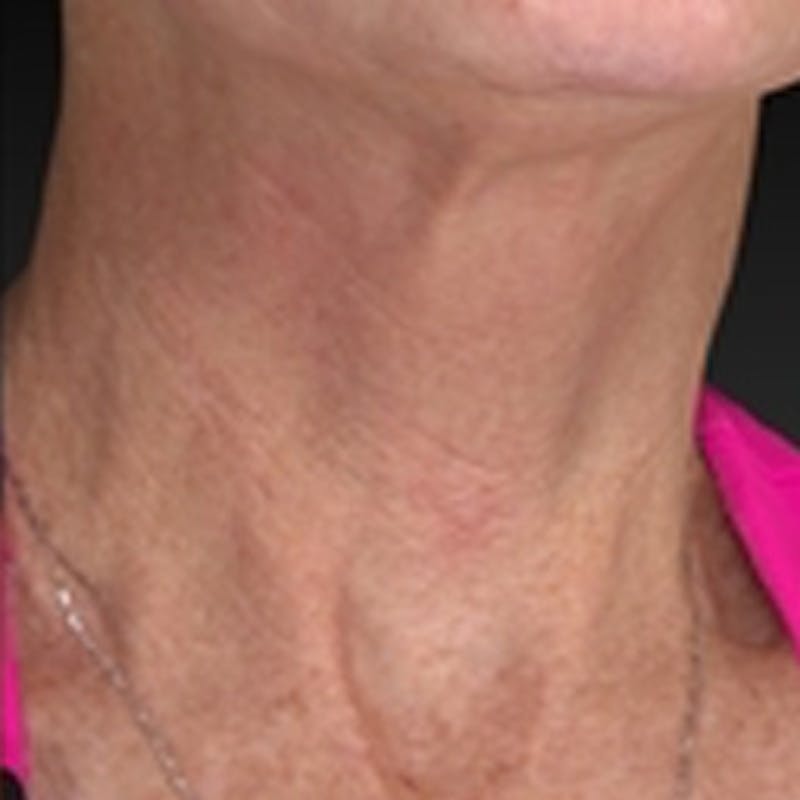 Laser Skin Rejuvenation Before & After Gallery - Patient 265117 - Image 4