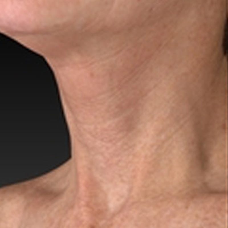 Laser Skin Rejuvenation Before & After Gallery - Patient 265117 - Image 5