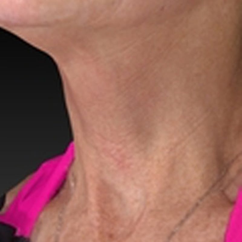 Laser Skin Rejuvenation Before & After Gallery - Patient 265117 - Image 6