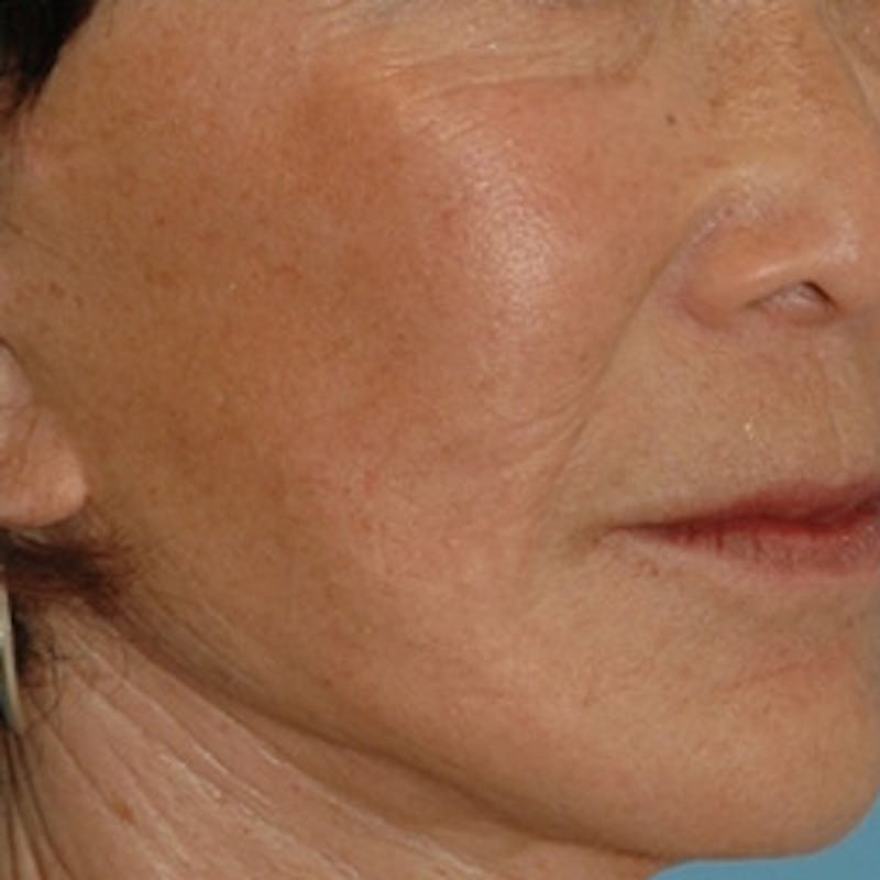 Laser Skin Rejuvenation Before & After Gallery - Patient 121588 - Image 2
