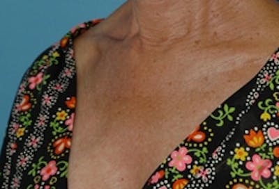 Laser Skin Rejuvenation Before & After Gallery - Patient 238260 - Image 1