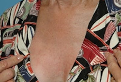 Laser Skin Rejuvenation Before & After Gallery - Patient 238260 - Image 2