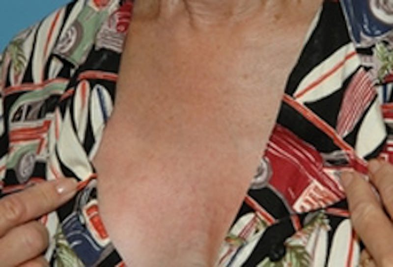 Laser Skin Rejuvenation Before & After Gallery - Patient 238260 - Image 2