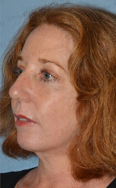 Laser Skin Rejuvenation Before & After Gallery - Patient 194424 - Image 2