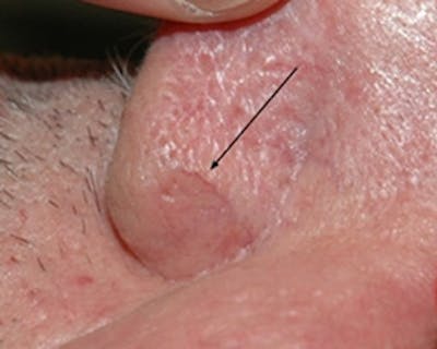 Nasal And Facial Vessels Before & After Gallery - Patient 118681 - Image 1
