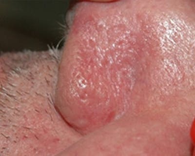 Nasal And Facial Vessels Before & After Gallery - Patient 118681 - Image 2